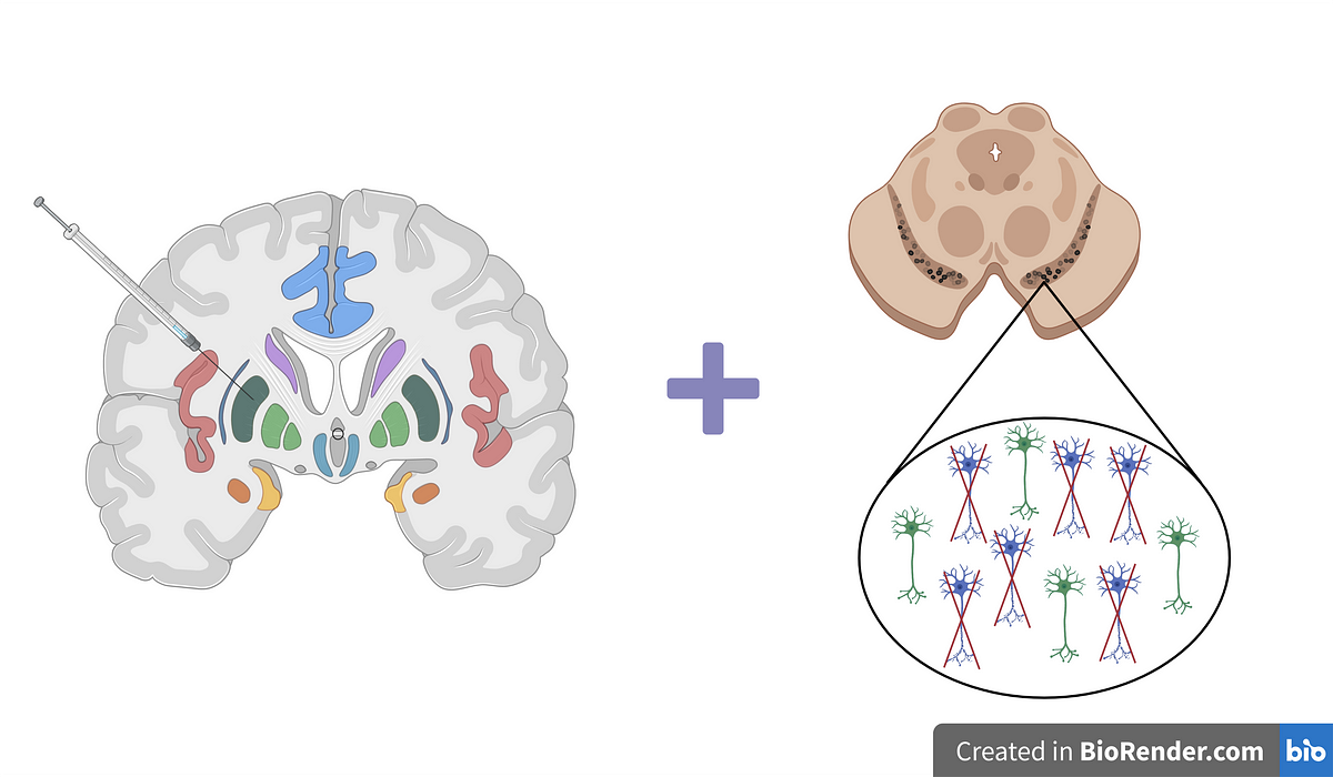 Combining Senolytics and Cell Therapy for the Treatment of Parkinson's Disease